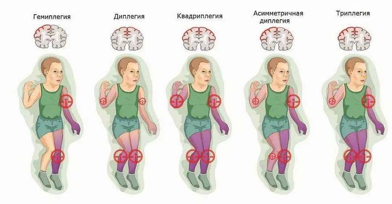 Топическая классификация описывает пораженные части тела на рисунке